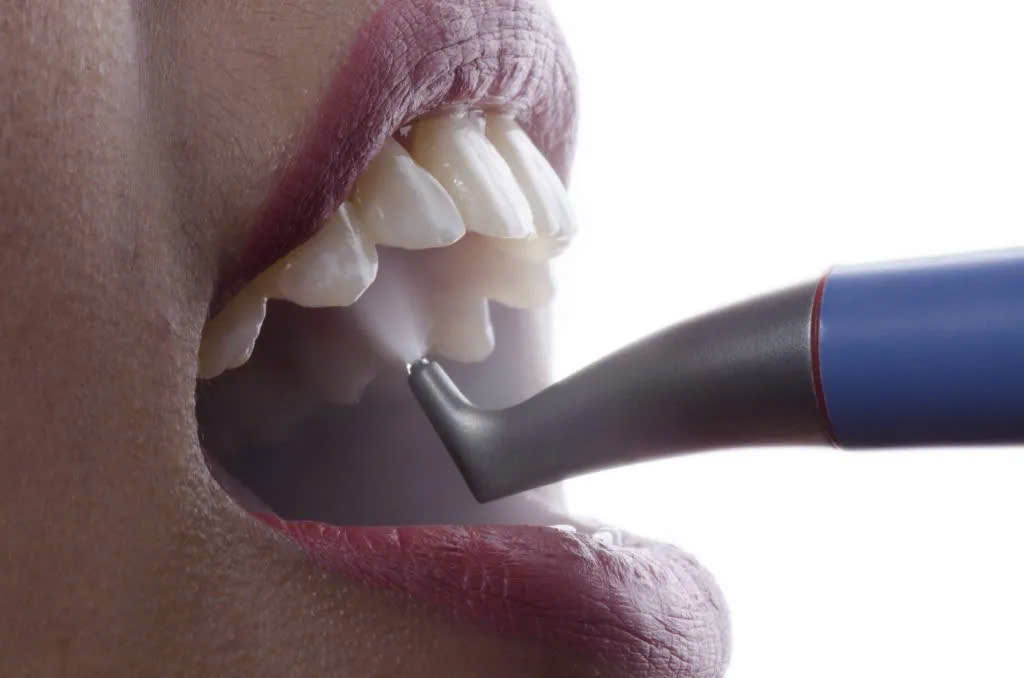 Ứng Dụng Thổi Cát Trong Điều Trị Nha Chu: Giải Pháp Êm Ái Và Hiệu Quả Vượt Trội