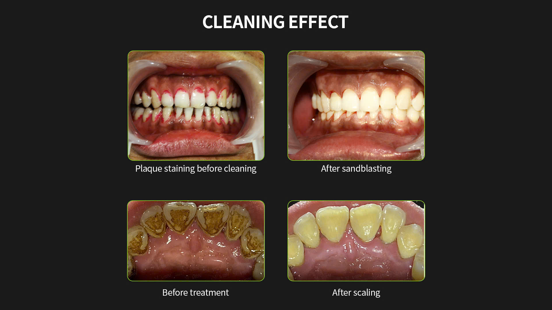 Thổi Cát Khác Lấy Cao Răng Như Thế Nào? Cần Lưu Ý Gì Để Răng Luôn Sạch Khỏe?