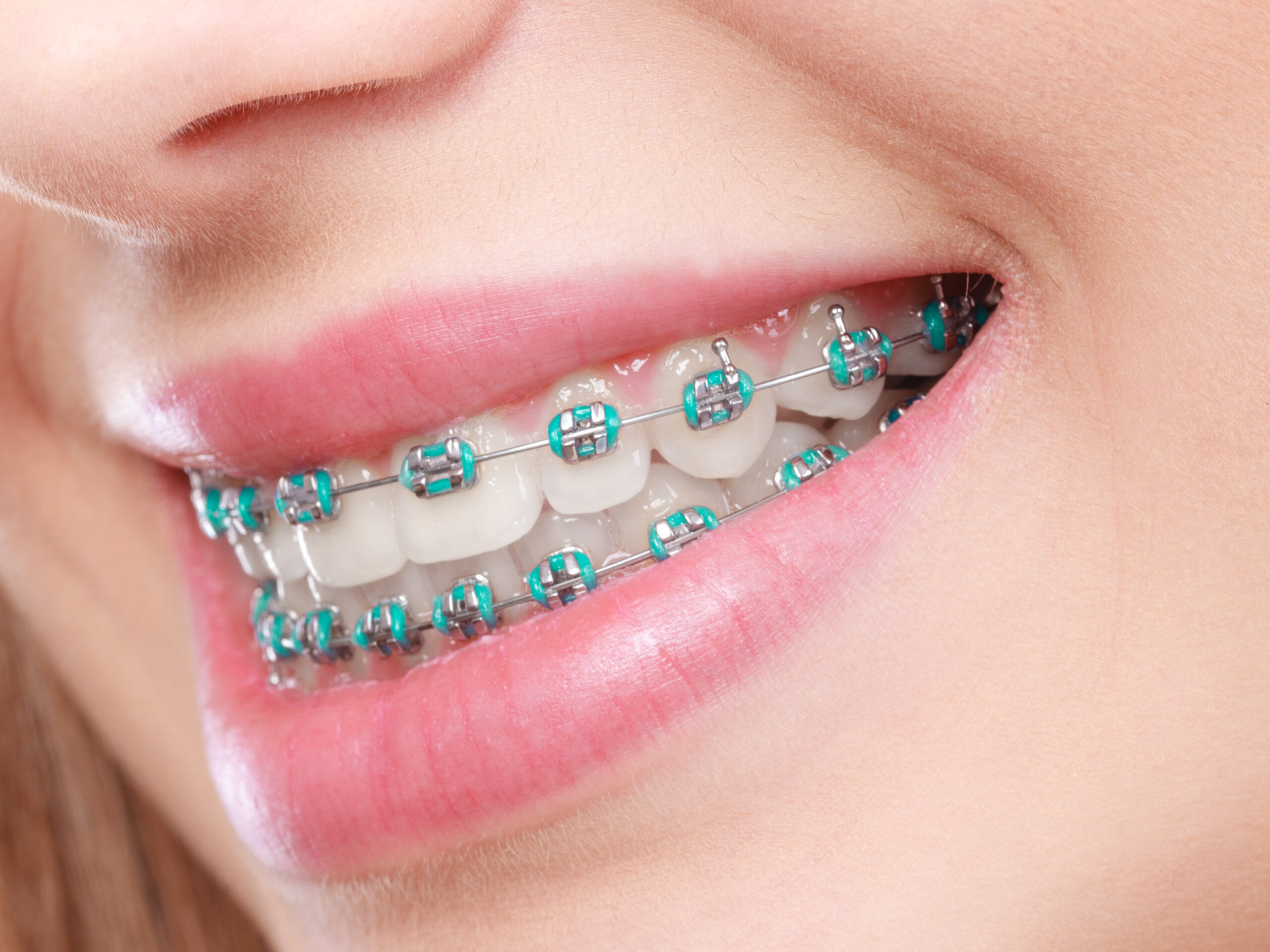 Niềng Răng Ở Đâu Uy Tín Tại Hà Nội? 10 Tiêu Chí Không Nên Bỏ Qua