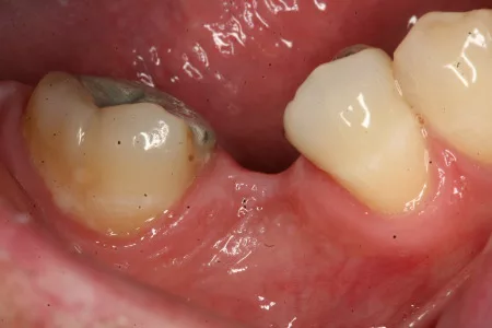 Mất Răng Bao Lâu Thì Bị Tiêu Xương Hàm?