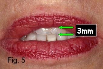 Độ Lộ Răng Cửa Khi Nghỉ Quan Trọng Như Thế Nào?