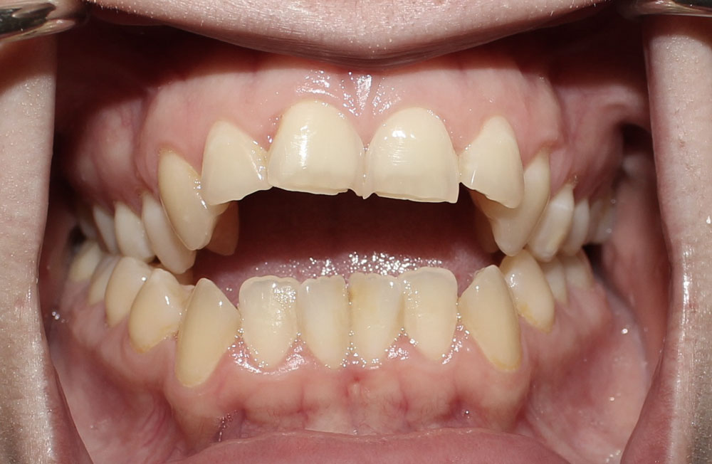 Cắn Hở Là Gì? Vì Sao Điều Trị Dễ Tái Phát?