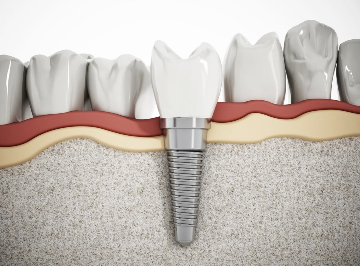 Implant Titanium Có An Toàn Không? Có Gây Dị Ứng Hay Đào Thải Không?