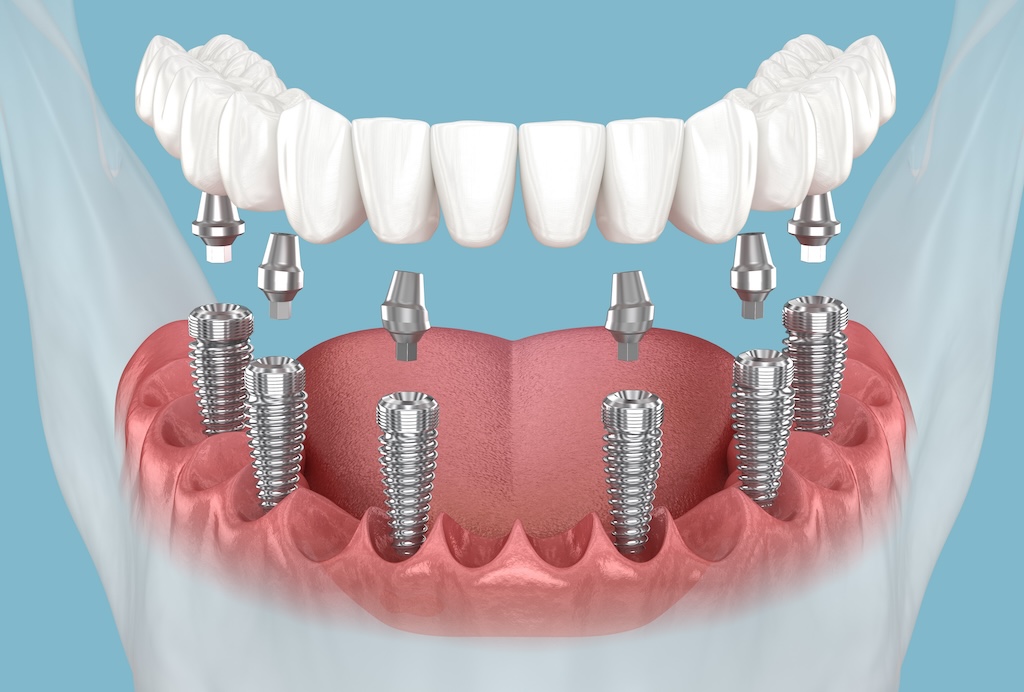 Mất Răng Toàn Hàm Nên Làm Hàm Tháo Lắp Hay Trồng Implant?