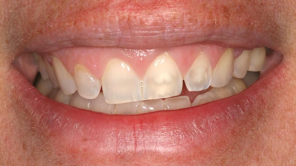 Mặt Phẳng Cười Bị Nghiêng Là Gì? Có Niềng Chỉnh Được Không?