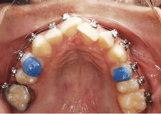 Nâng Khớp Khi Niềng Là Gì? Vì Sao Phải Nâng Khớp?