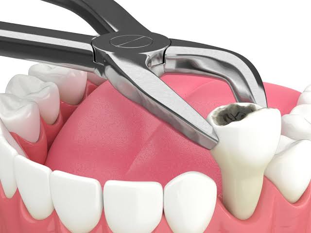 Khi Nào Niềng Răng Cần Nhổ Răng?