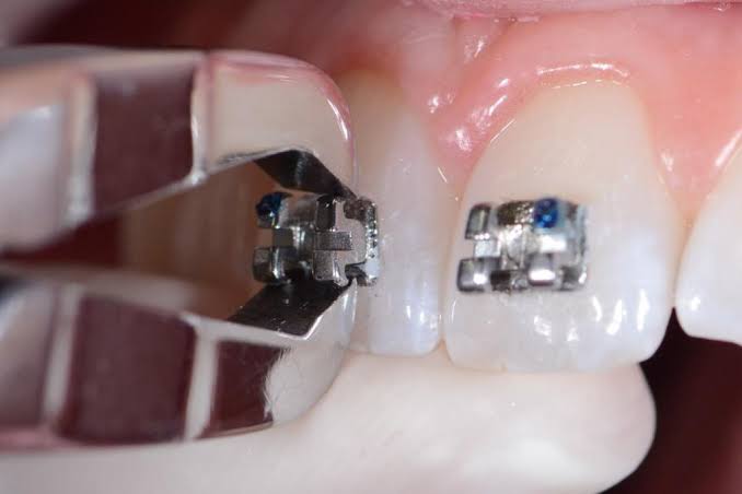 Sau Khi Tháo Niềng Có Cần Tạo Hình Lợi, Tẩy Trắng Hay Phục Hình Không?