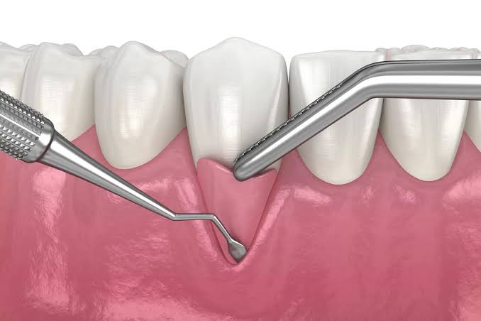 Nướu Quanh Implant Khác Nướu Quanh Răng Thật Như Thế Nào?
