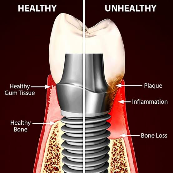 Làm Thế Nào Để Giữ Xương Và Nướu Quanh Implant Ổn Định Lâu Dài? Hướng dẫn quan trọng cho bệnh nhân implant.