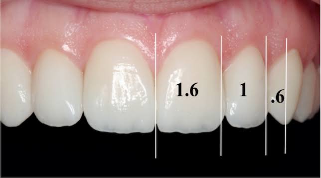 Một Ca Niềng Răng Đẹp Phải Được Đánh Giá Bằng Những Tiêu Chí Nào? Góc nhìn từ niềng răng thẩm mỹ.