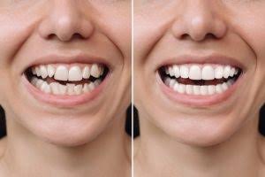 Cung Cười Là Gì? Vì Sao Cung Cười Quyết Định Nụ Cười Trẻ Trung?
