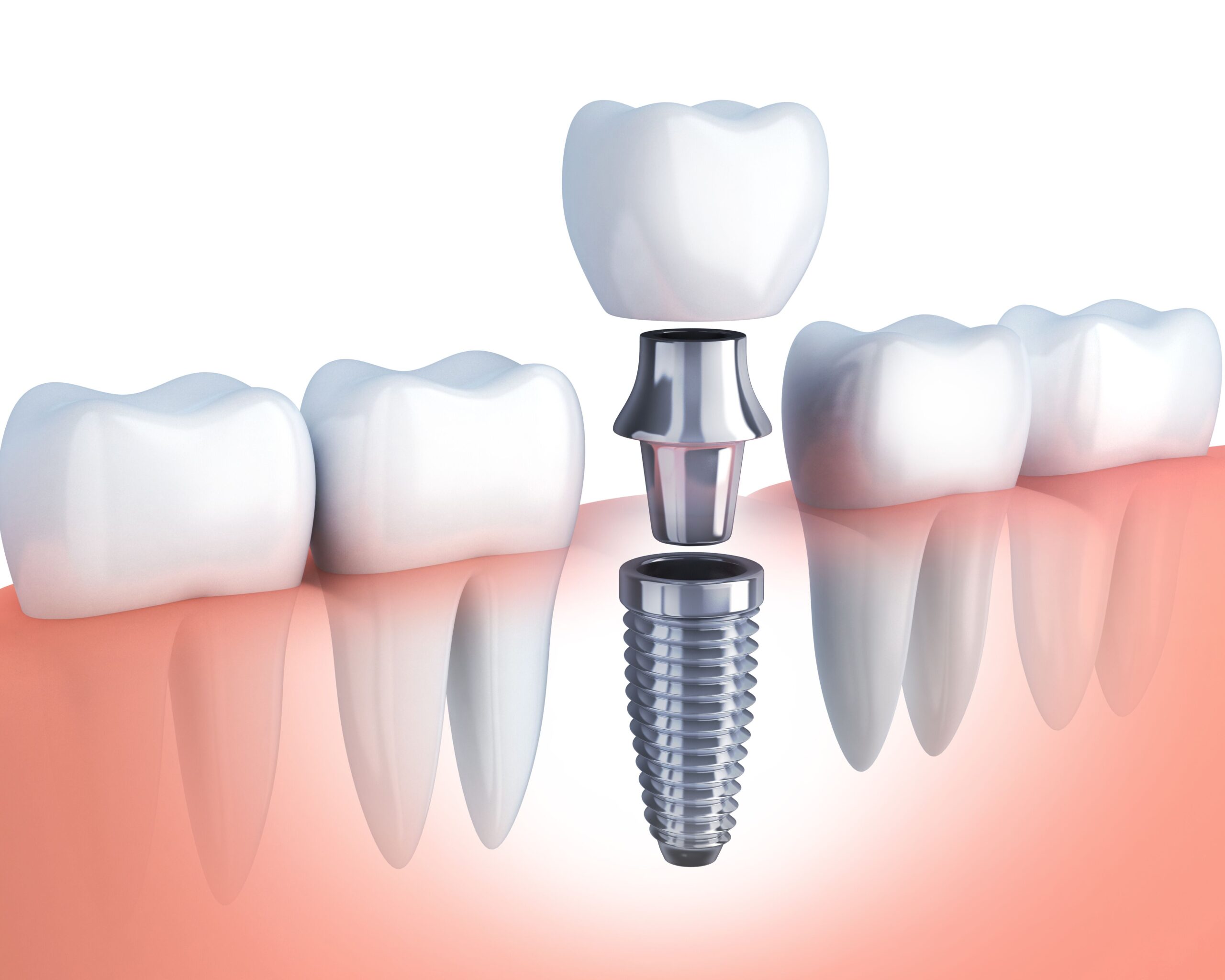 Chất Lượng Xương Ảnh Hưởng Đến Implant Như Thế Nào?