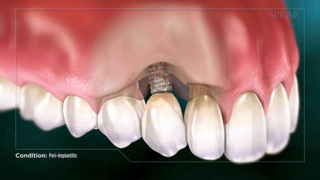 Vì Sao Xương Quanh Cổ Implant Có Thể Tiêu Sau Khi Lắp Răng một thời gian?